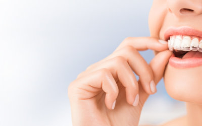 Brace Yourself: 10 Things You Never Knew About Invisalign Retainers