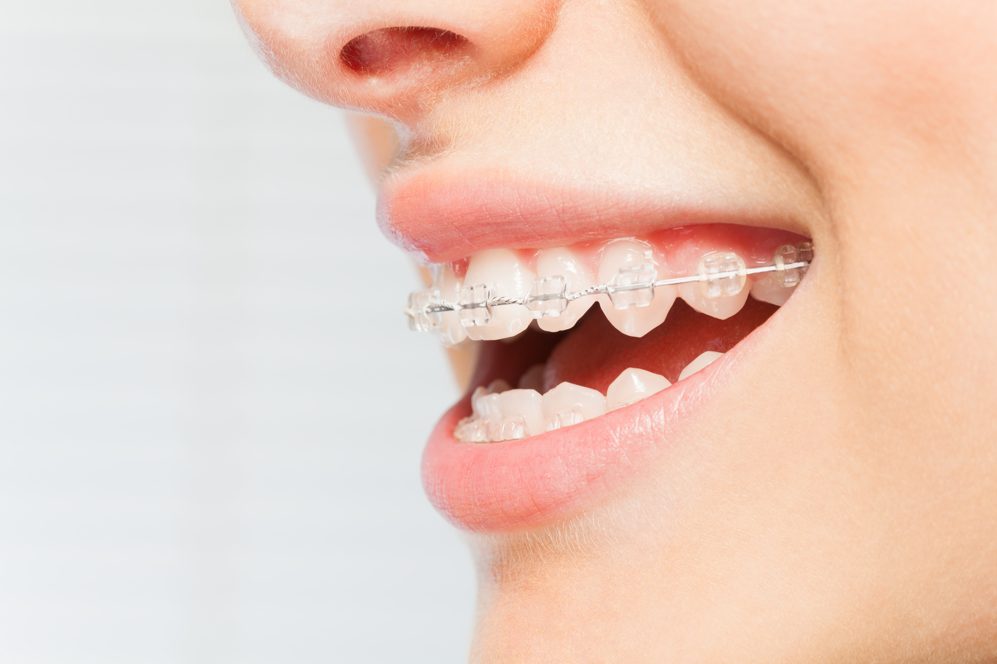 Pain For Braces at Diana Glass blog