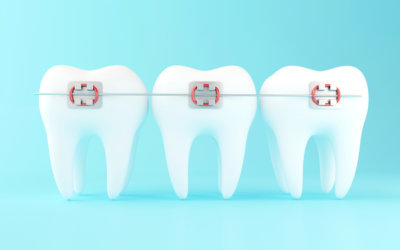 The Complete Braces Care Checklist for New Users in Glenview, IL