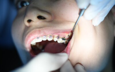 Exploring the Different Types of Braces in Glenview, IL